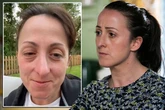 EastEnders' Natalie Cassidy reveals swollen face as she 'can't breathe' from hayfever