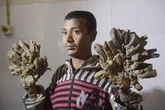 'Tree-man' syndrome where incurable condition causes agony and bark-like growths