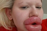 'I spent £20,000 on world's biggest lips - people think I've had allergic reaction'