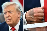 Donald Trump sparks health fears as massive bruise spotted on President's hand
