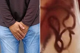 Doctors find 'giant human parasite' living inside man's bladder after cooking mistake