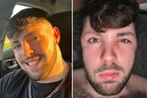 Man's head swells 'like a balloon' as he ignores 'no sex' rule after Turkey hair transplant