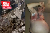 '9/11 gave me breast cancer – my body swelled like balloons and went as red as raw steak'