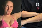 Billie Eilish covered in bite-marks and bruises as she strips to tiny bikini