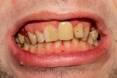 British Army rejects scores of applicants because they have bad teeth