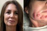 'Dodgy Botox treatment left me with horrific scars and too embarrassed to show my face'