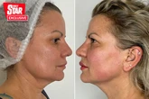'I spent £2k on one-hour miracle treatment that makes me look 10 years younger'