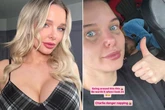 Helen Flanagan's painful black eye after she splashes out on £400 beauty treatment