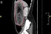 Horrified medics pull giant hairball out of 17-year-old 'Rapunzel's' stomach
