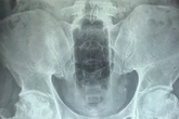 Doctors remove 20cm bottle from bloke's bum after he gets it stuck while 'cleaning himself'