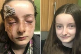 Schoolgirl, 12, suffers horror facial burns trying microwave egg 'hack' seen online