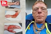 'I spent six months in hospital after pouring a chip pan of boiling oil over myself'