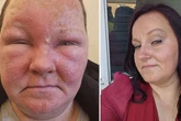 Woman wanted to 'rip off own face' after horror reaction to common cream