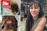 Teen's hair dye hell as 'hairdresser burns hole in scalp – and still charges her £37'