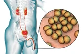 UK cases of drug-resistant gonorrhoea rise as warning over 'global threat' issued