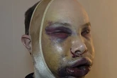 Influencer left 'unrecognisable and blind' after extreme facelift that surgeons in Turkey refused