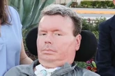 Neuralink's first ALS brain implant patient reveals plans for telepathic wheelchair