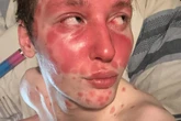 'I looked like an alien when fillers gave me psoriasis - but I found miracle product'