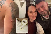 Dad suffers 100 bed bug bites at Haven resort as family