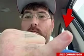 Bloke with ‘world’s smallest micropenis’ launches fundraising appeal for enlargement op