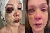 Woman knocked out in viral brawl 'left with brain trauma' as she breaks silence