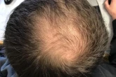 Secret cure for hair loss may finally have been discovered – and it's an ancient remedy