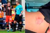 Liverpool legend's nephew 'bit' by 'scruffy bastard' opponent shows off gruesome injury