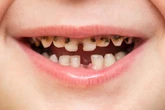 Yorkshire kids have worst teeth in UK as one place has 995 extractions in a year