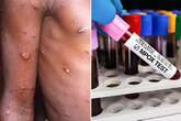 NHS lists eight mpox symptoms to look out for as deadly strain spreads to UK