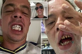 'My Turkey teeth are falling out and it will cost £40k to fix - don't make my mistake'