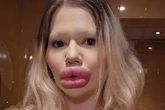 Woman with 'world's biggest lips' is refused filler by doctors – but still won't stop