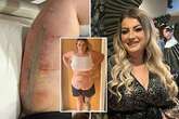 Mum left with 'rotting' tummy tuck becomes 'first Brit to sue over botched op'