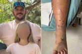 Man fighting for life after being infected with flesh-eating bacteria on fishing trip