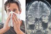 Man who thought he had runny nose all the time told it was something else - brain leak