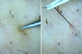 Ingrown hair like 'rubber band' pulled free from leg in oddly satisfying video