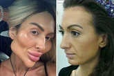 Model with 'world's biggest cheeks' shows what she looked like as natural 26-year-old