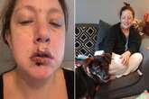 Woman 'traumatised' after own dog chewed chunk of her lip off but she doesn't blame her