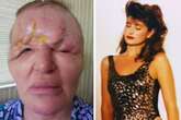 Model left looking like a 'monster' after botched treatment caused her head to 'collapse'