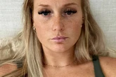 Anti-wrinkle jabs 'poisoned' my body and left me partially paralysed