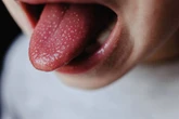 Five Scarlet fever symptoms to spot as illness that mostly affects children spreads