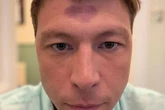 GB News star Patrick Christys opens up on forehead bruise before going live on air