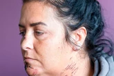Mum and daughter scarred for life after dog rips into faces in horror attack