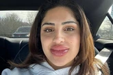 Woman's lip filler dissolving treatment goes wrong and she's left looking like Bratz doll