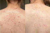 Teens see 'real difference' in spot-prone skin after using 'life-changing' serum