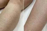 'Best hair removal method' shoppers 'have tried' is now £140 off