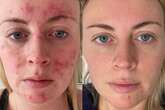 Thousands say 'life-changing' serum from 47 Skin is a 'miracle worker' for scars and blemishes