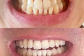 Shoppers praise teeth whitening product that 'removes stains' in time for summer holidays