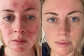 Dermatologist-approved anti-blemish serum praised for 'giving confidence back'