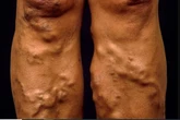 Warning issued for anyone who has varicose veins to act now