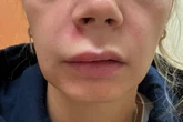 Woman rushed to hospital after popping spot in 'triangle of death' on her face